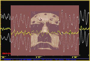 EEG after concussion