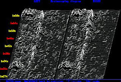 EEG after concussion