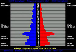 EEG after concussion