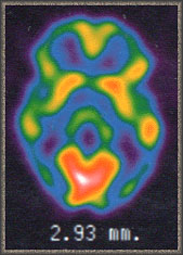 PET scan after concussion