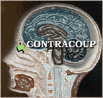 Contracoup - Brain Injury Mechanisms