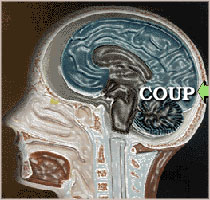 Coup Brain Injury Mechanisms