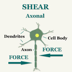 Axonal shearing