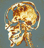 Mri